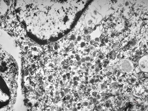 F,68y. | caecum - carcinoid F,68y. | caecum - carcinoid